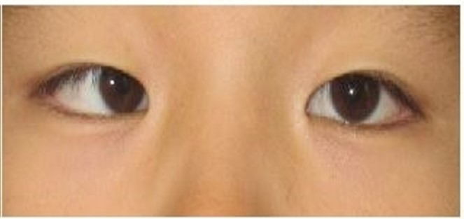 家长容易忽视危害性又大的常见儿童眼病：斜视和弱视